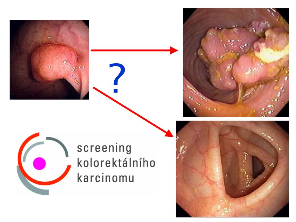 Screening kolorektálního karcinomu Screening kolorektálního karcinomu